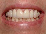Dental Veneers Toronto