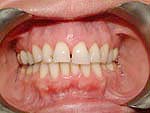 Dental Veneers Yorkville